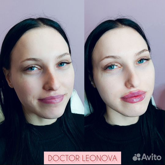 Увеличение губ у врача