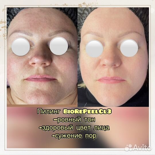 Смас (smas) лифтинг