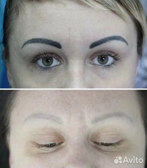 Удаление татуажа и тату