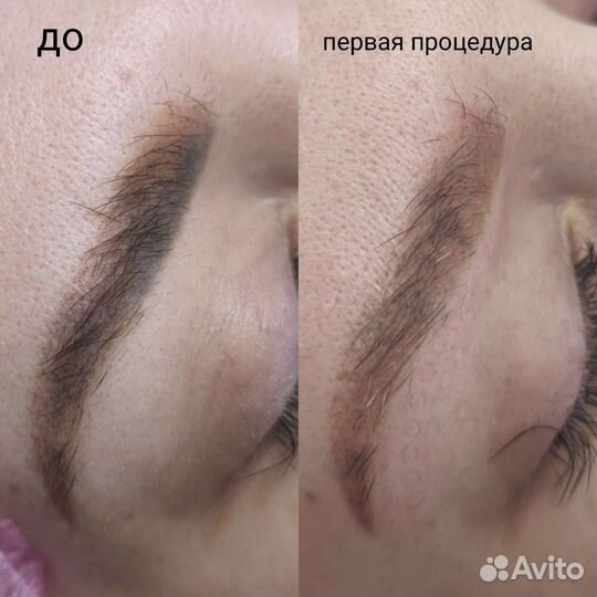 Осветление татуажа