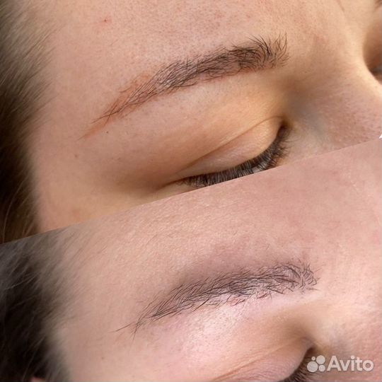 Удаление тату/татуажа