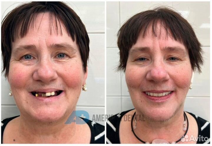 Постоянный протез + 4 импланта (ALL on 4)