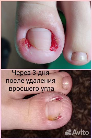 Подолог, педикюр, вросший ноготь, бородавка