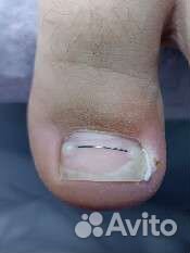 Установка титановой нити