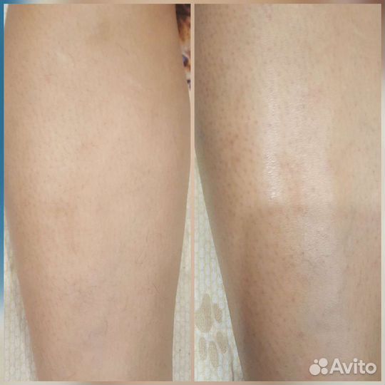 Депиляция воском: верхняя губа