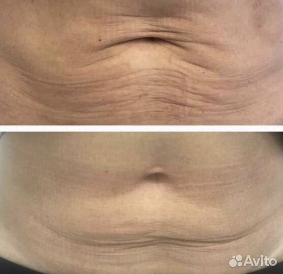 Лечение угревой сыпи