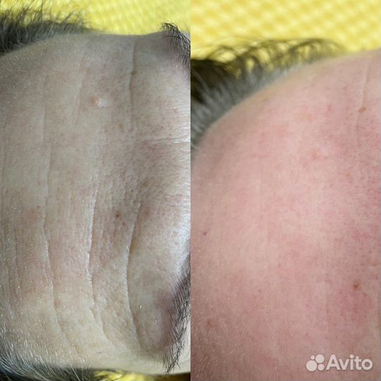 Испанский хиропластический массаж лица