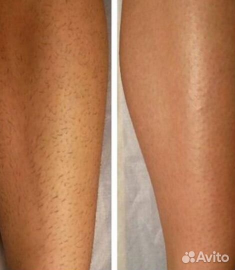 Лазерная эпиляция Элос