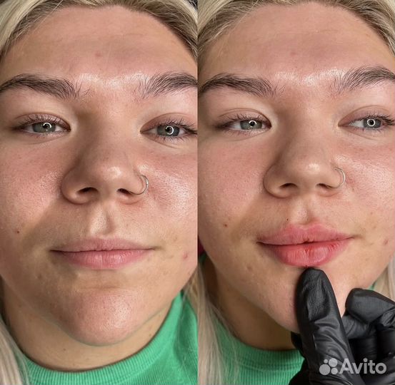 Обучение косметологии ботокс нити. Гос.диплом