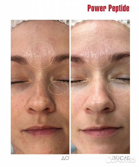 Пептидный пилинг dermaquest - набор на 4 процедуры