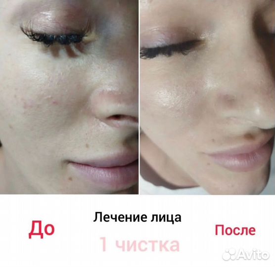 Услуги косметолога массаж лица