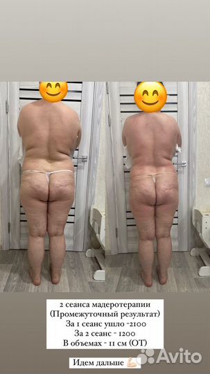 Мадеротерапия скалками