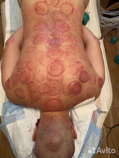 Массаж вакуумный, висцеральный, обучение хиджаме