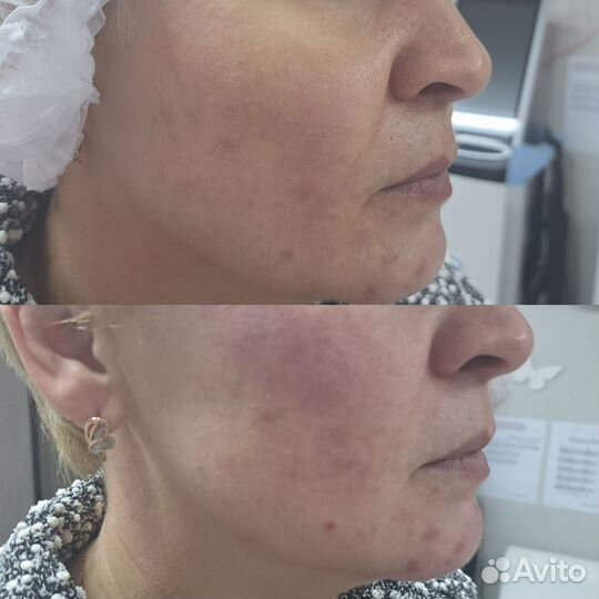 Процедура SMAS лифтинг