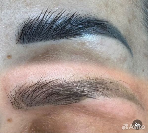 Удаление татуажа