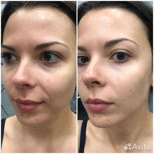 Smas Подтяжка лица и тела без пластики