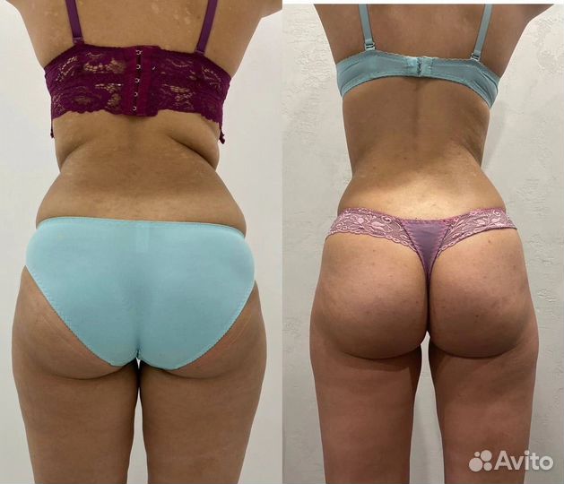 Требуются модели по коррекции фигуры и похудению