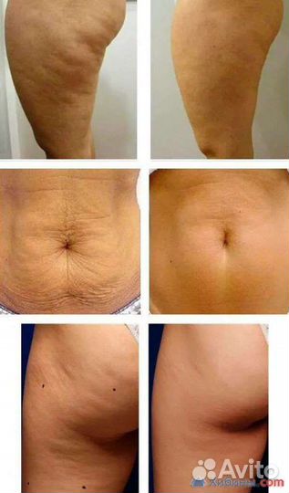 LPG массаж, EMS sculpt