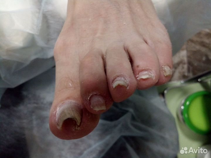 Лечебный педикюр