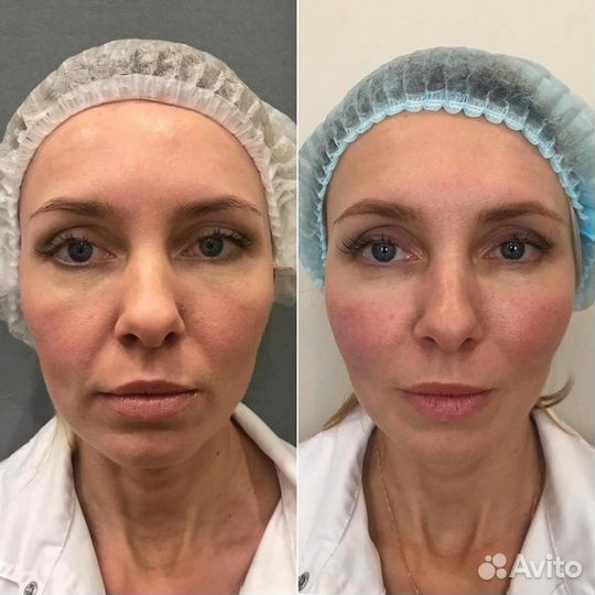 СМАС лифтинг подтяжка лица