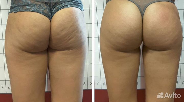 Антицеллюлитный массаж