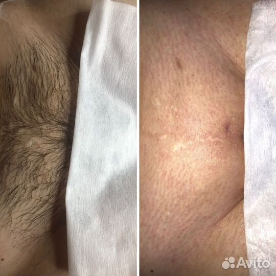 Депиляция воском: глубокое бикини