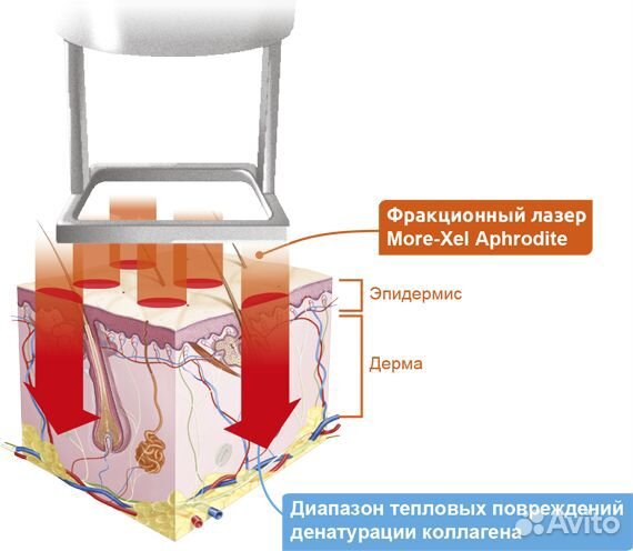 Лазер со2 для гинекологии