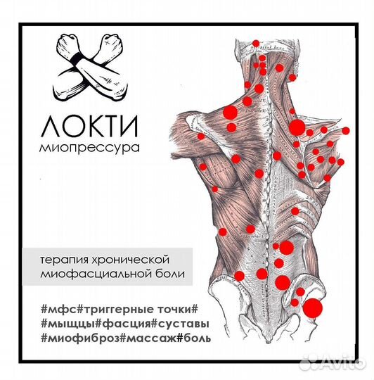 Миотерапия, лечение хронической боли, выезд на дом