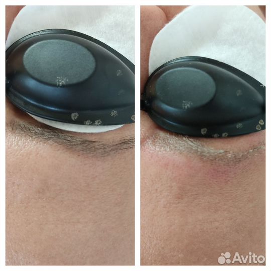 Лазерное удаление тату и татуажа