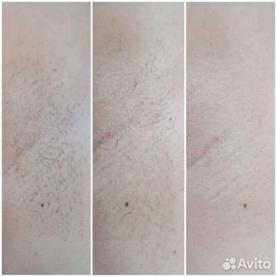 Депиляция, Шугаринг, Новая Охта