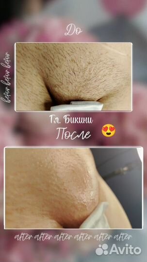 Женский Шугаринг