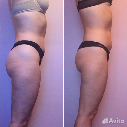 Массаж LPG и Шугаринг