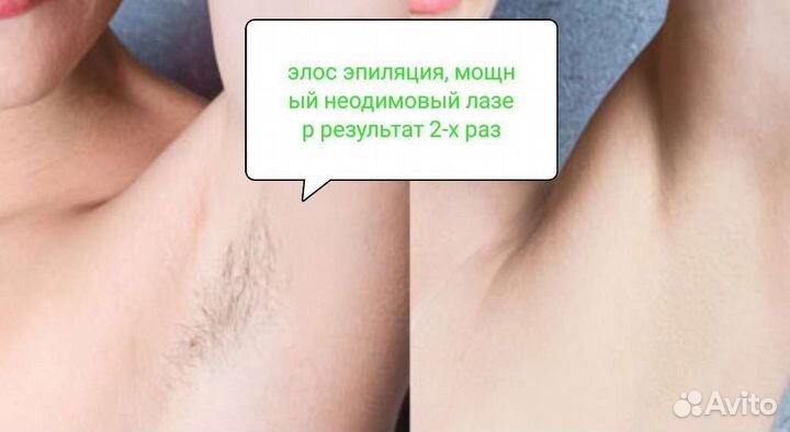 Лазерная эпиляция