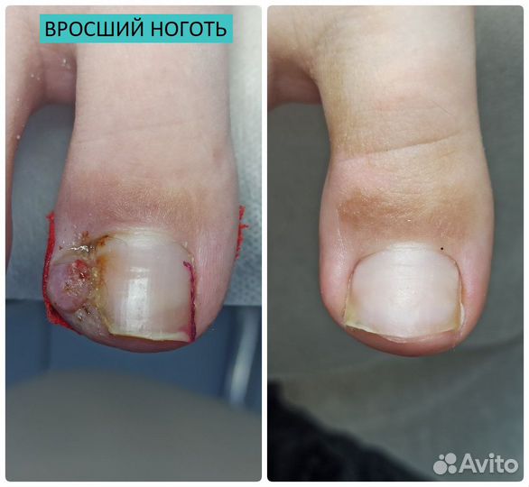 Медицинский педикюр. подолог