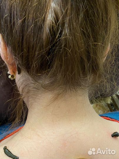 Пиявки гирудотерапия