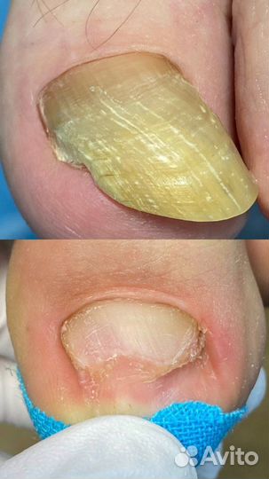 Модель с вросшими ногтями и мозолями