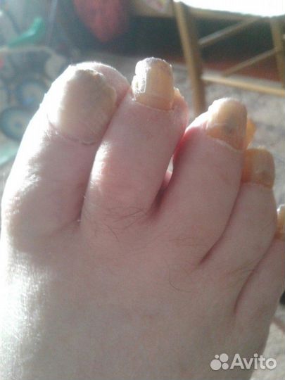 Лечебный педикюр проблемных ног