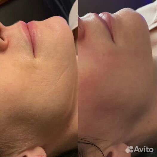 Сплэш-лифтинг массаж лица