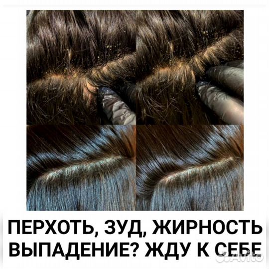 Трихолог,лечение выпадения волос,перхоти,жирности