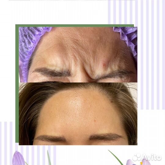 Смас (smas) лифтинг