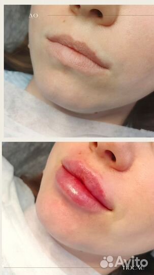 Косметолог:Увеличение губ,ботокс,уходы,прокол ушей