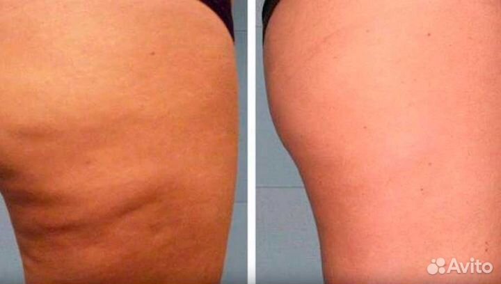 Аппаратный массаж