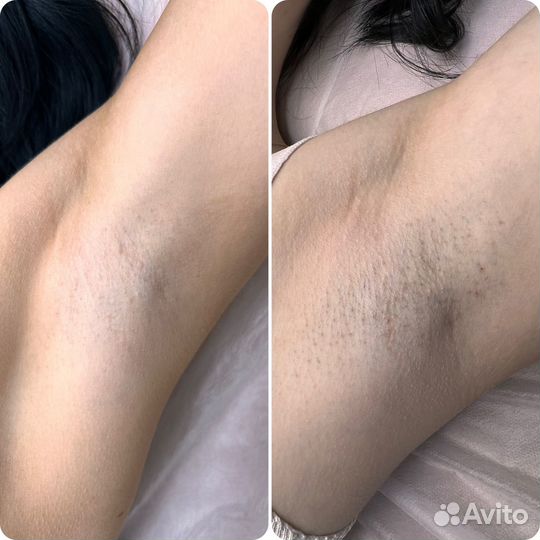 Лазерная эпиляция