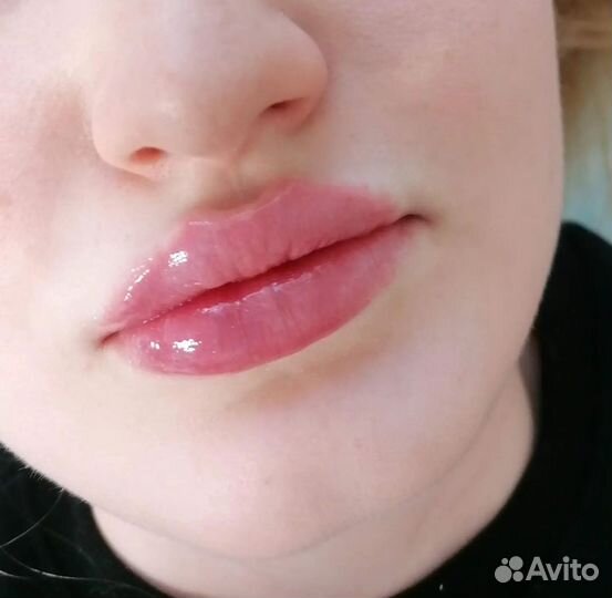 Увеличение губ