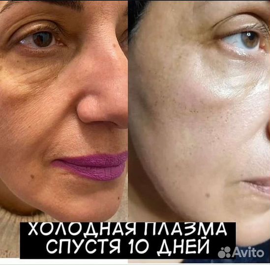 Холодная плазма