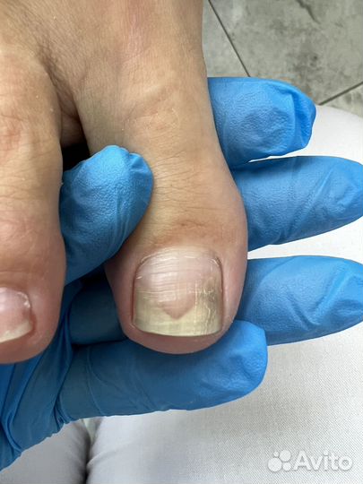 Отслоение Травмированный ноготь Подолог