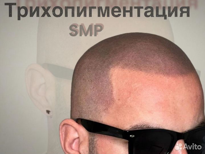 Трихопигментация головы SMP