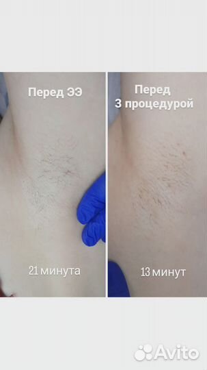 Электроэпиляция