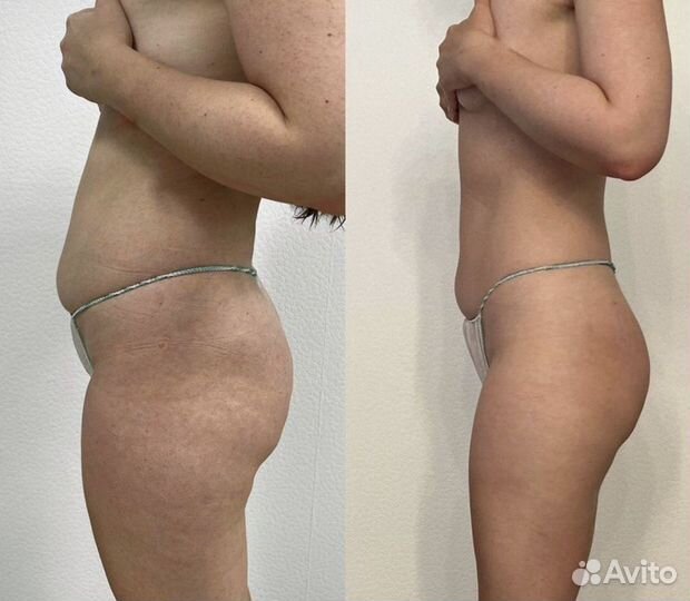 Похудение/Вакуумный массаж+ RF/Ультр. кавитация