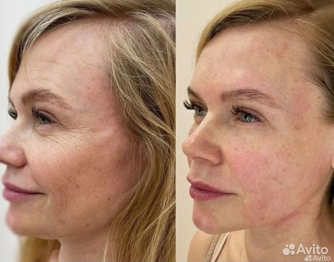 СМАС лифтинг подтяжка лица